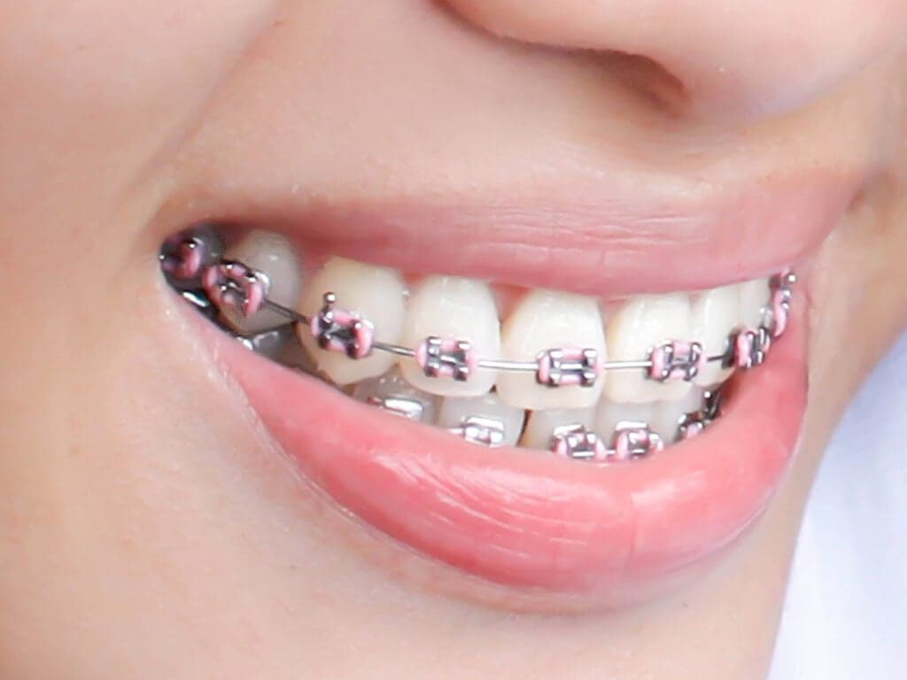 Things to know before getting braces in Johns Creek