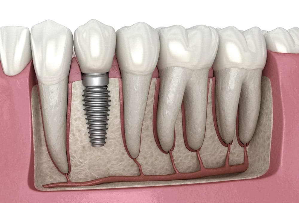What makes dental implants a long-term solution