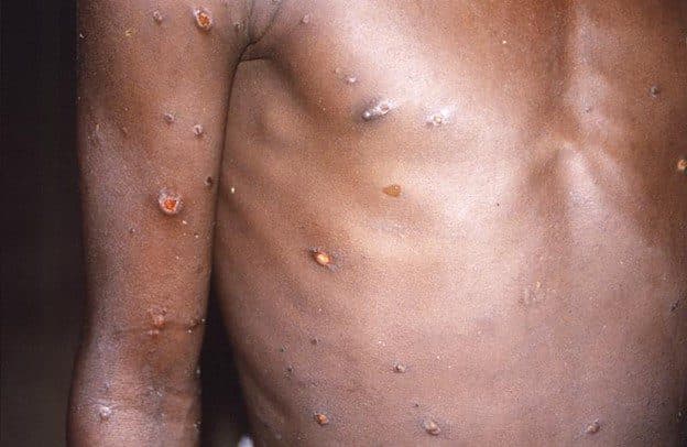 The Americas now reporting highest number of Monkeypox cases