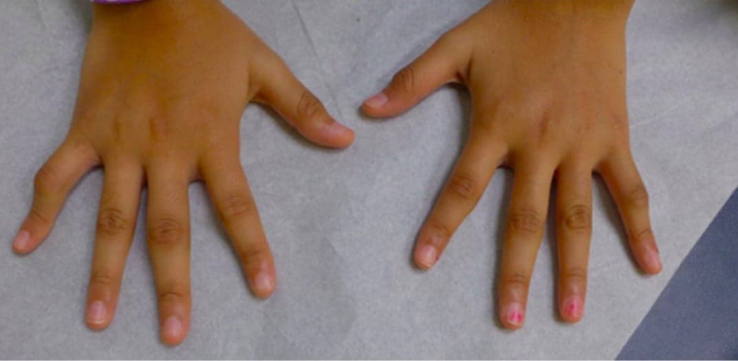 Can children be diagnosed with arthritis?