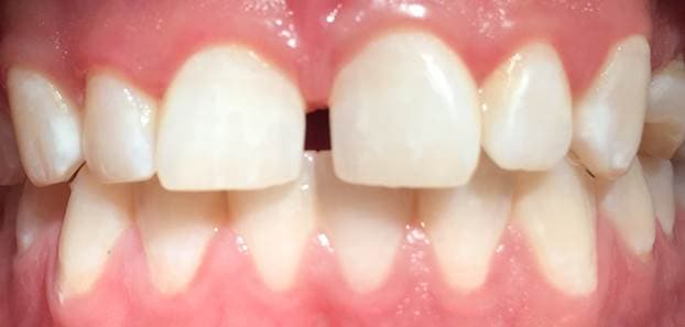 #HealthFeature: What is Dental Attrition?