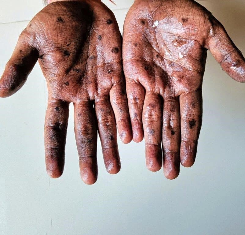 Barbados denies case of Mpox