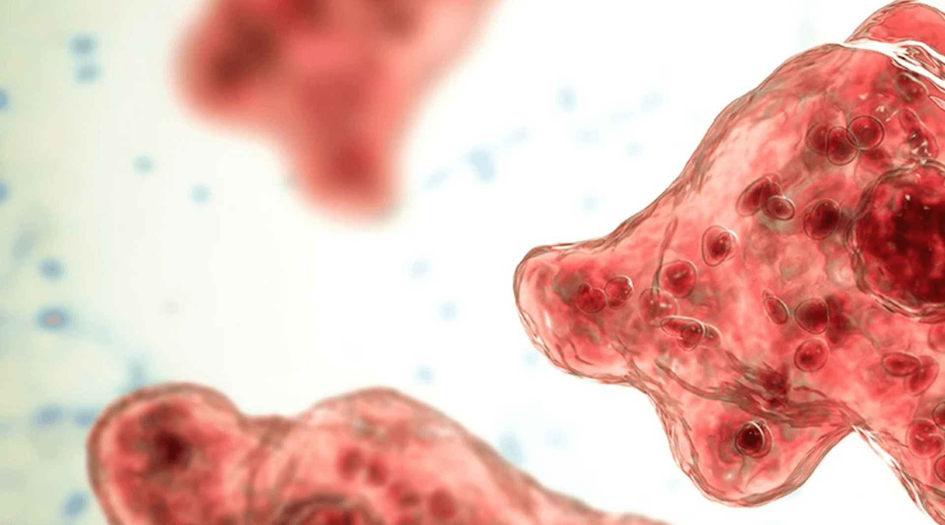 Brain-eating amoeba kills Florida resident, possibly due to sinus rinse with tap water