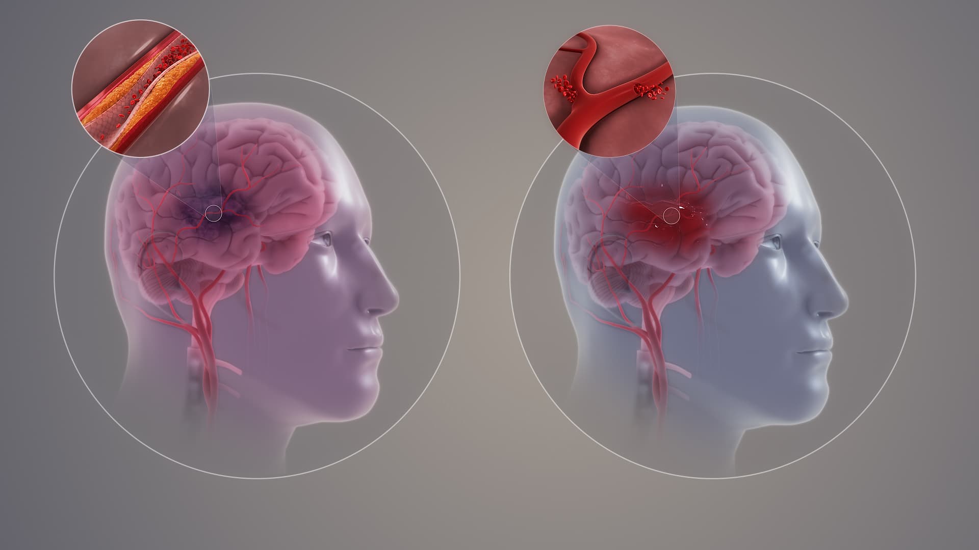 How to Help Prevent a Stroke