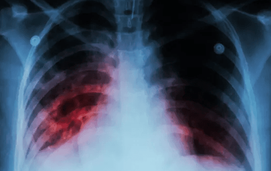 Caribbean lead to way with fight against TB