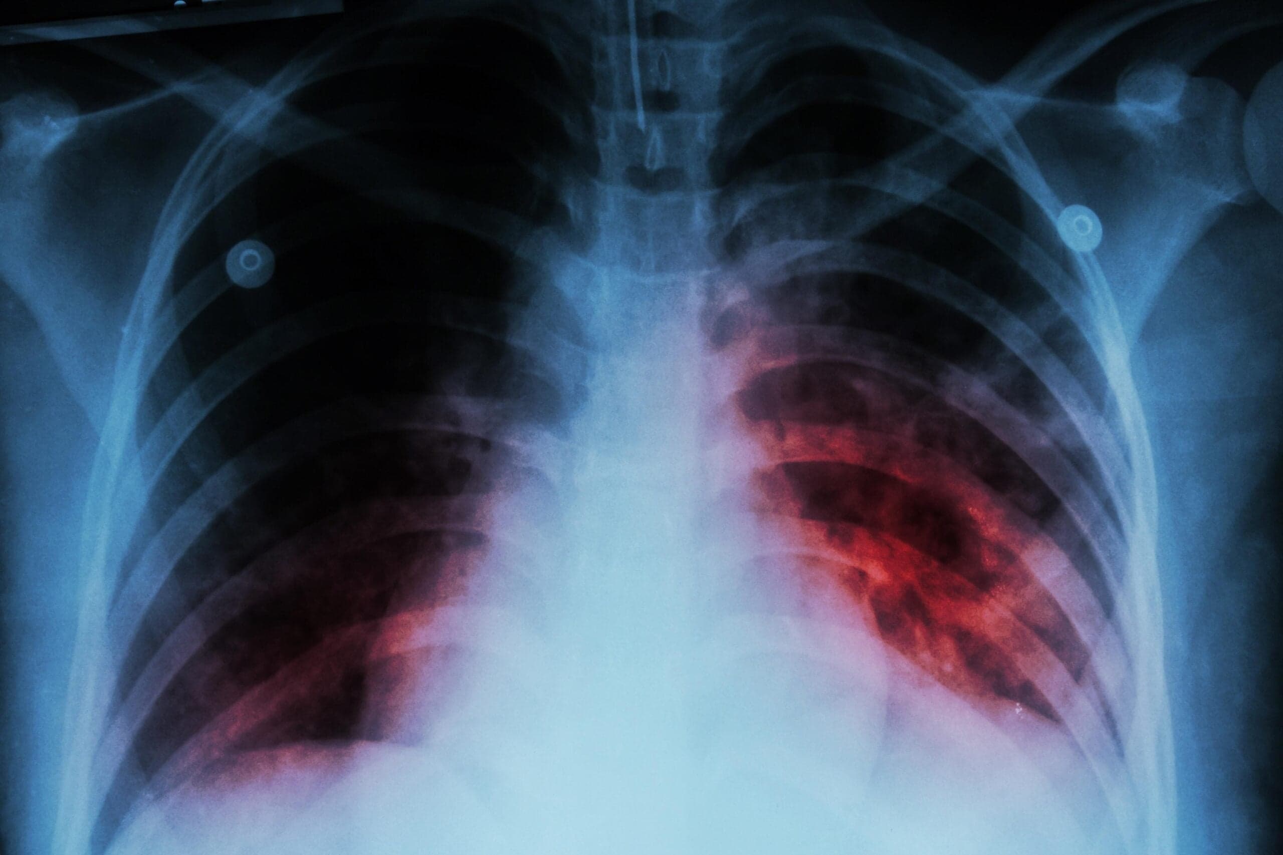 Grenada investigating tuberculosis cases as infections rise