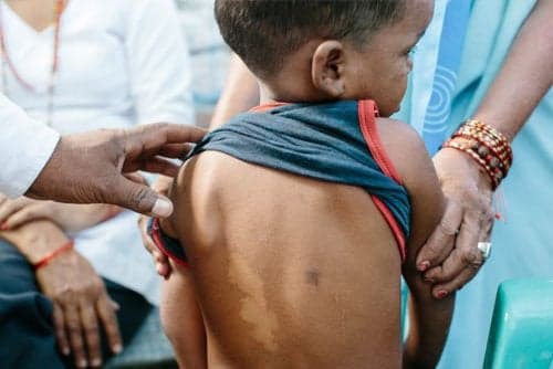 St. Lucia Health Ministry notes uptick in leprosy cases in 2023