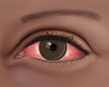 Conjunctivitis outbreak in Barbados hospital