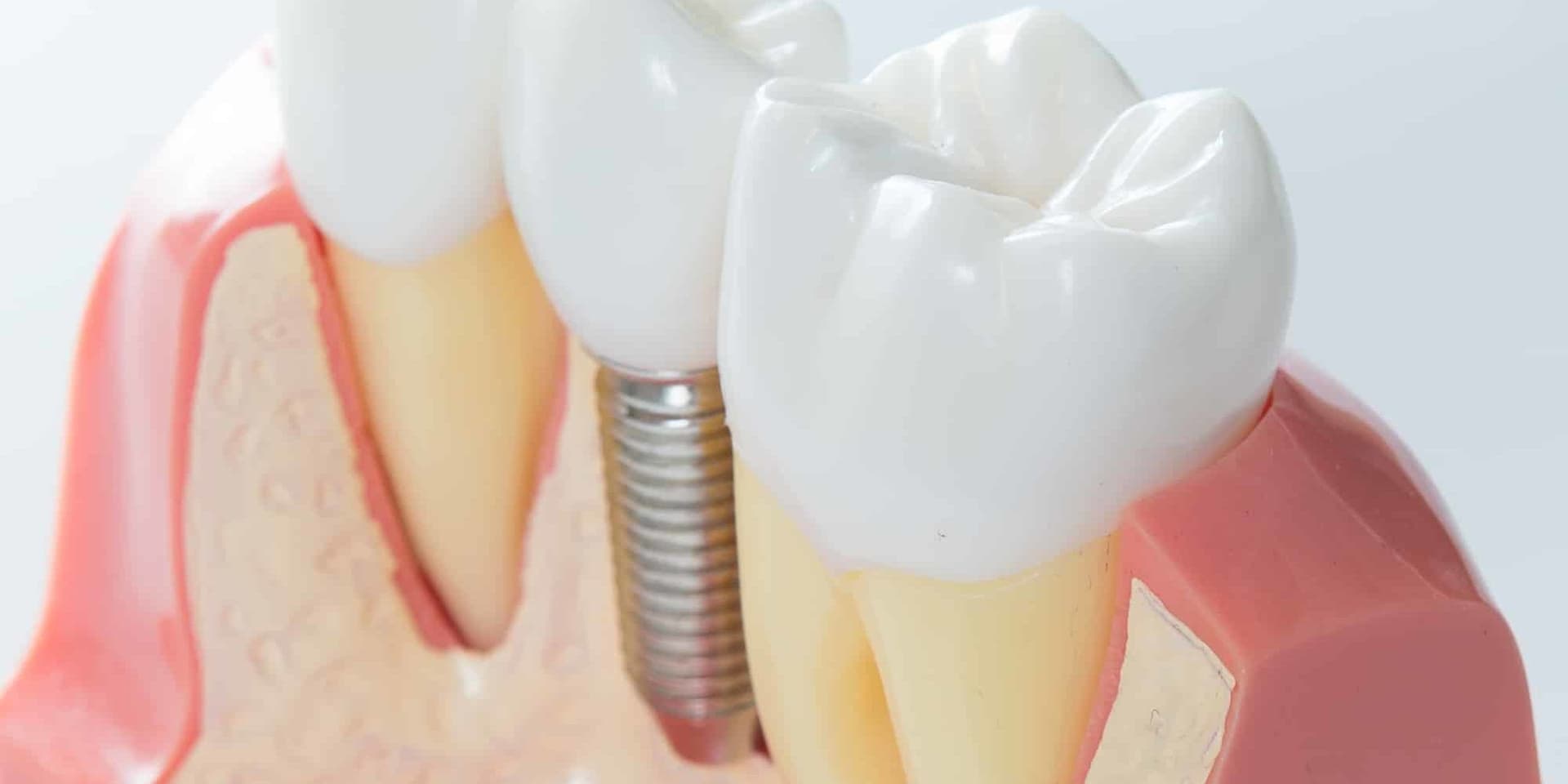 Dental Implants: The Optimal Tooth Replacement