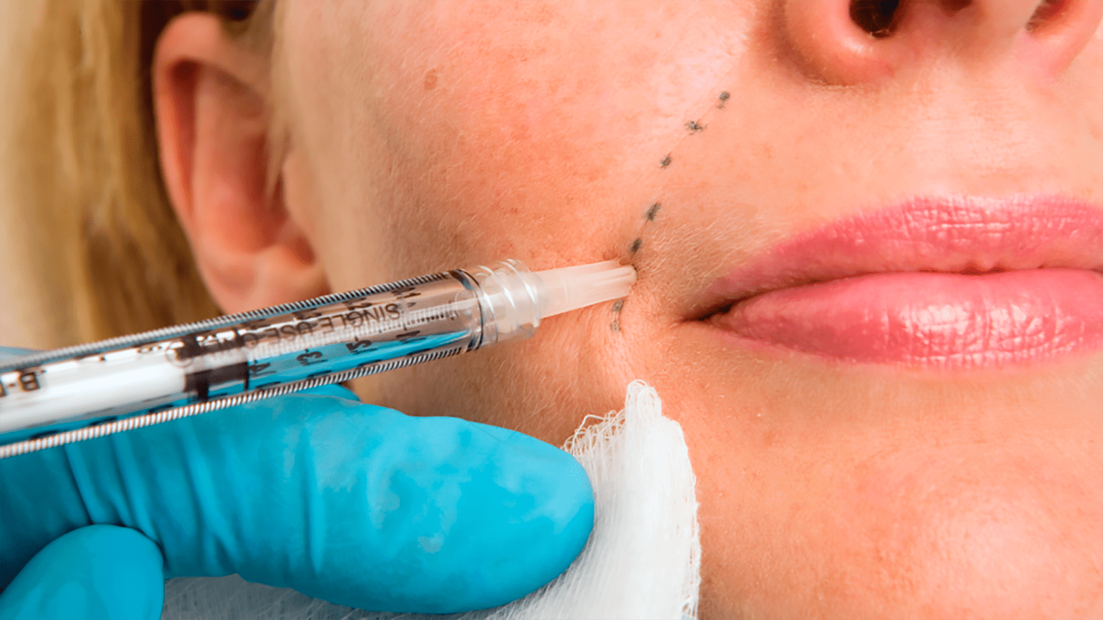 The Science and Art of Youthful Skin: A Comprehensive Guide to Dermal Fillers