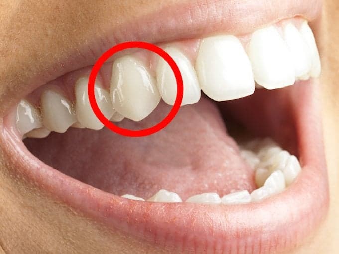 #HealthFeature: What's An Eye Tooth?