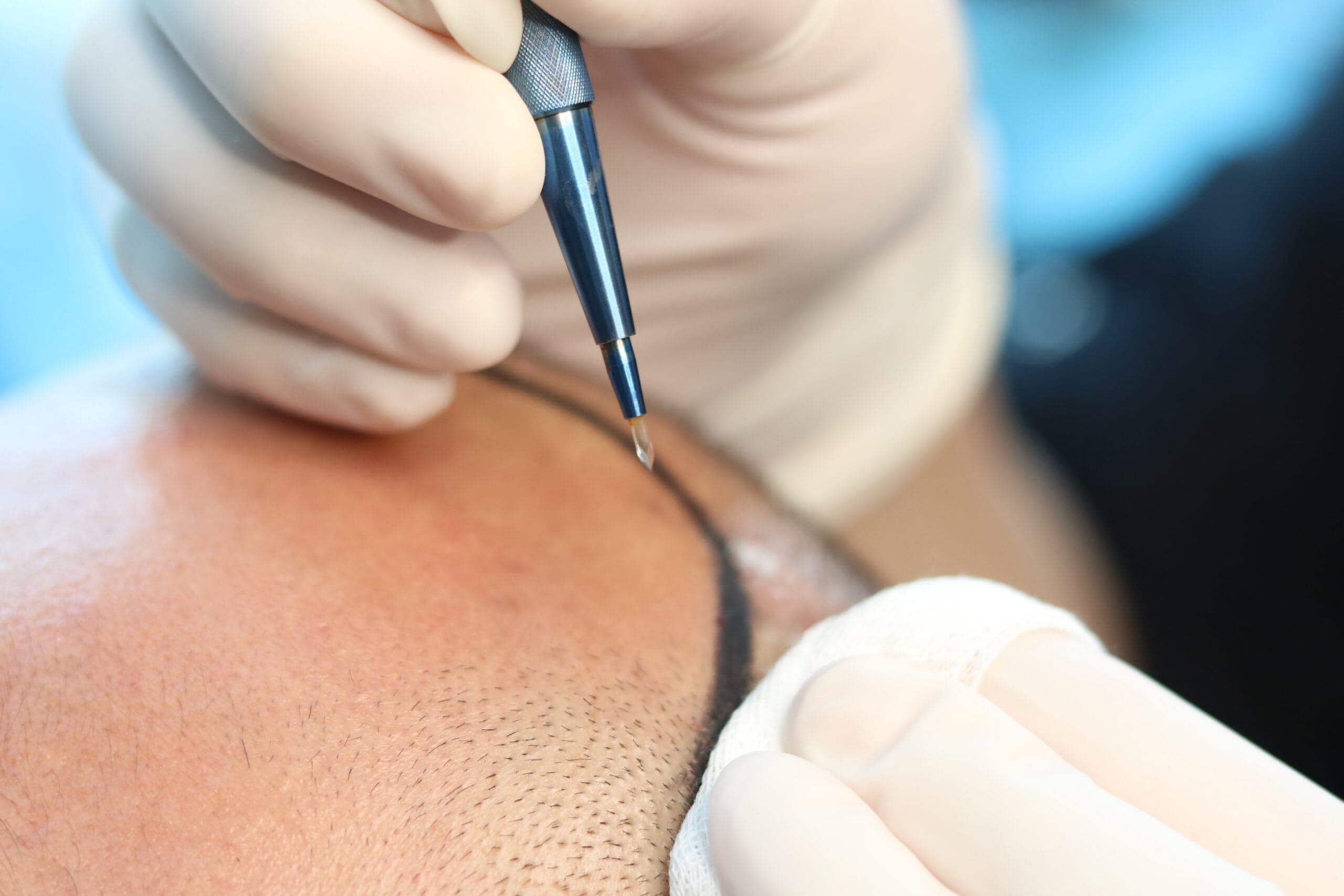 Comprehensive hair transplant solutions in Istanbul with Estenove