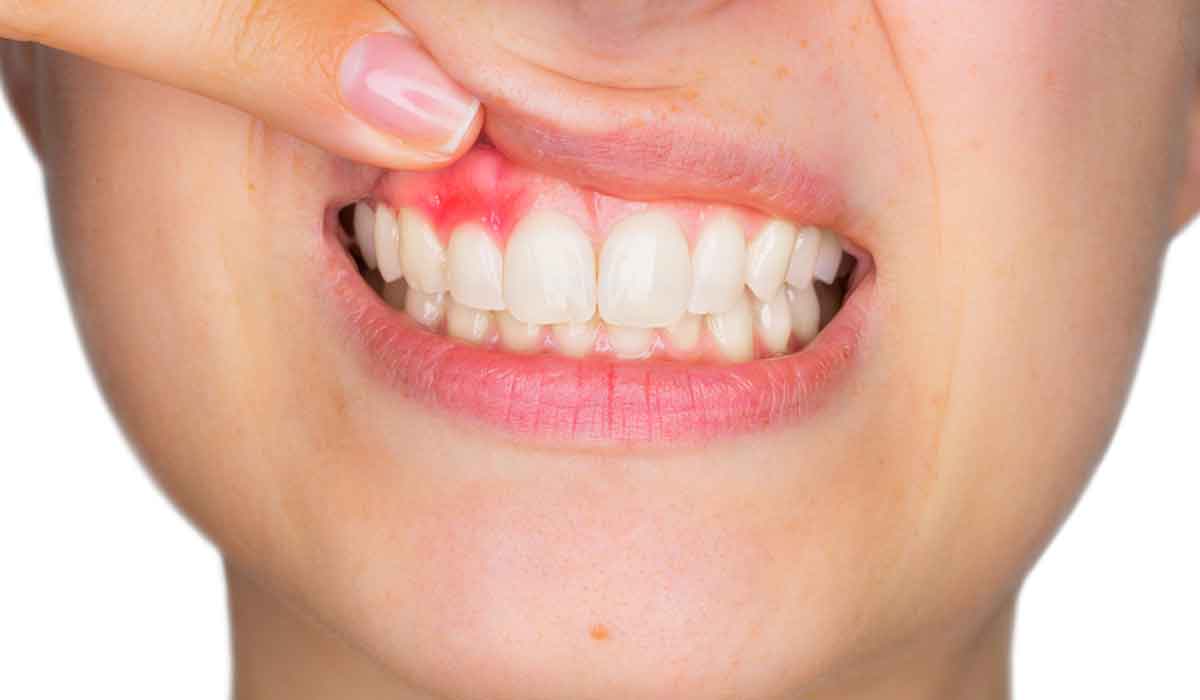 #DentalFeature: Do Gums Grow Back? The Number One Concern About Gum Recession