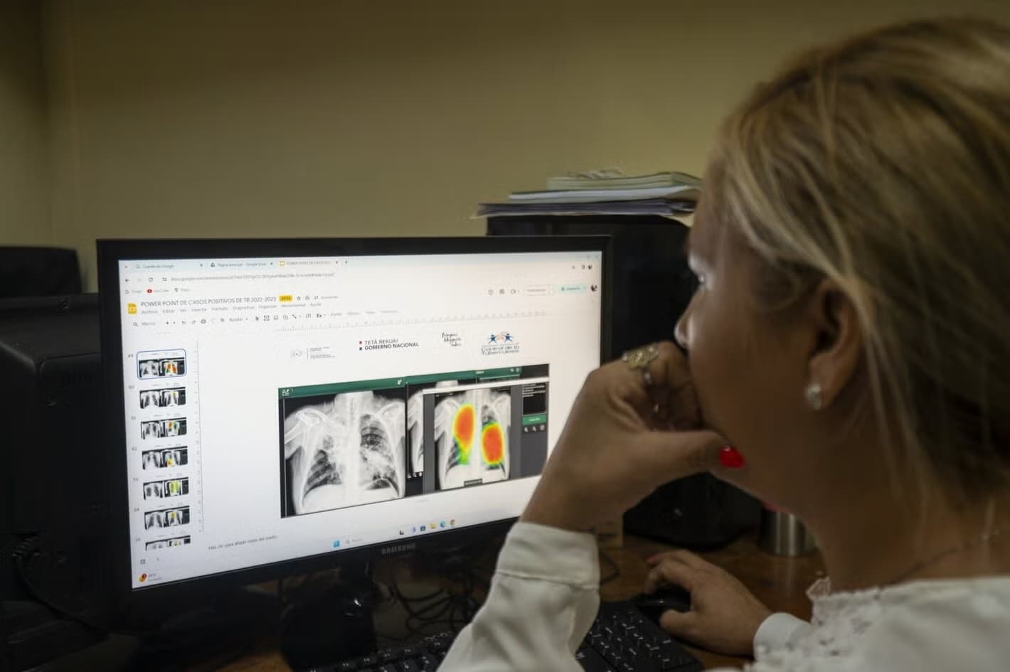 Tuberculosis cases surge in the Americas, says PAHO