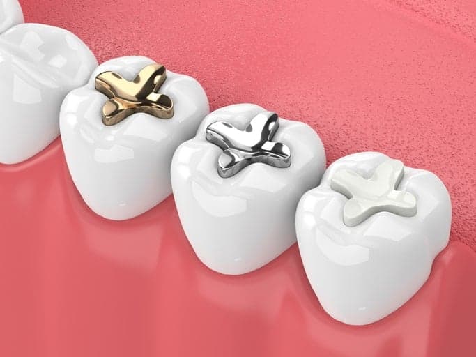 #DentalFeature: Metal Vs. Metal-Free Fillings