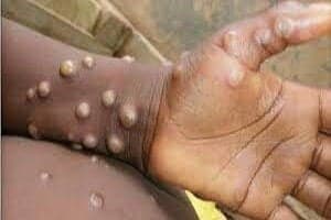 Jamaica confirms first locally transmitted case of Monkeypox