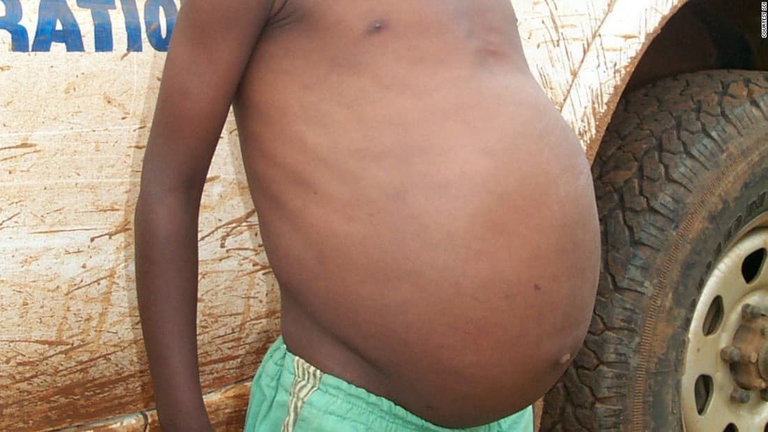 St. Lucia health ministry to conduct medical survey for schistosomiasis