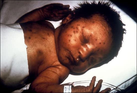 Barbados Health officials issue syphilis warning