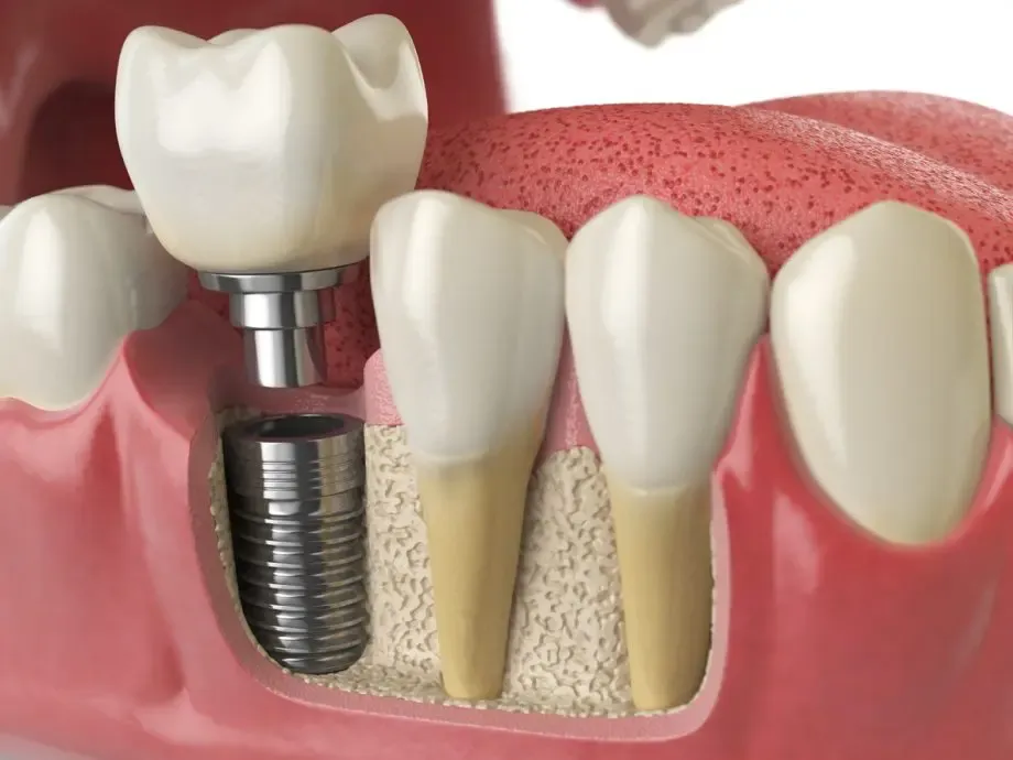Step-by-step tooth implant procedure: From consultation to recovery