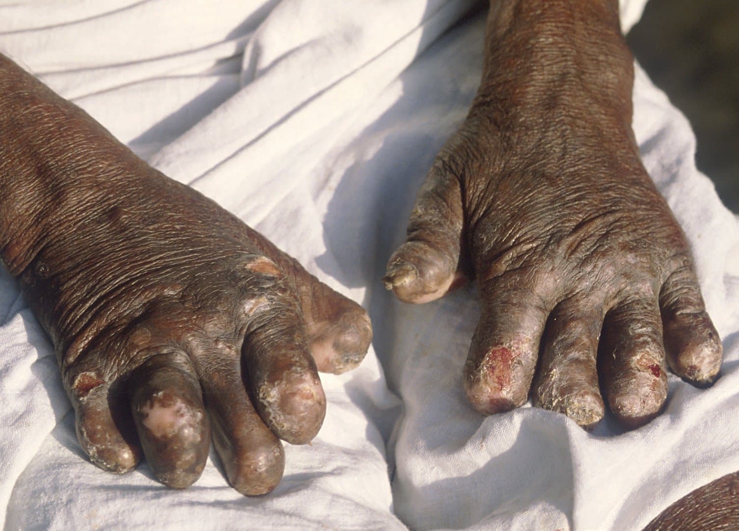 Haiti sees increase in leprosy