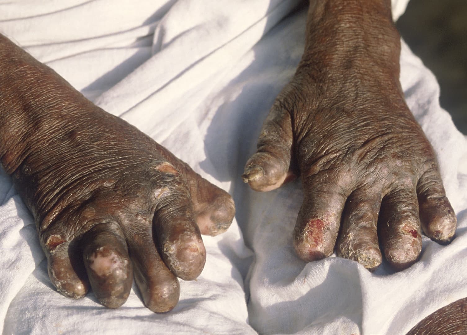 Haitian Contracts Leprosy in Chile