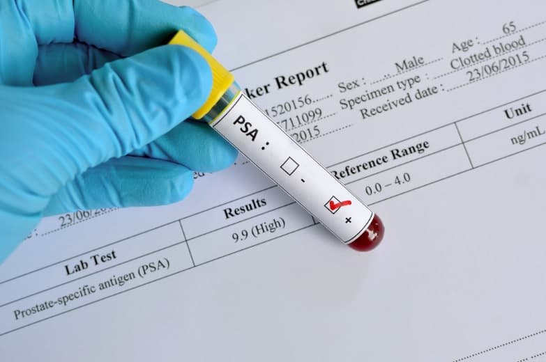 Afro-Caribbean men deemed most at risk for prostate cancer