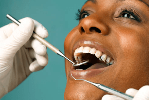 The truth about white fillings