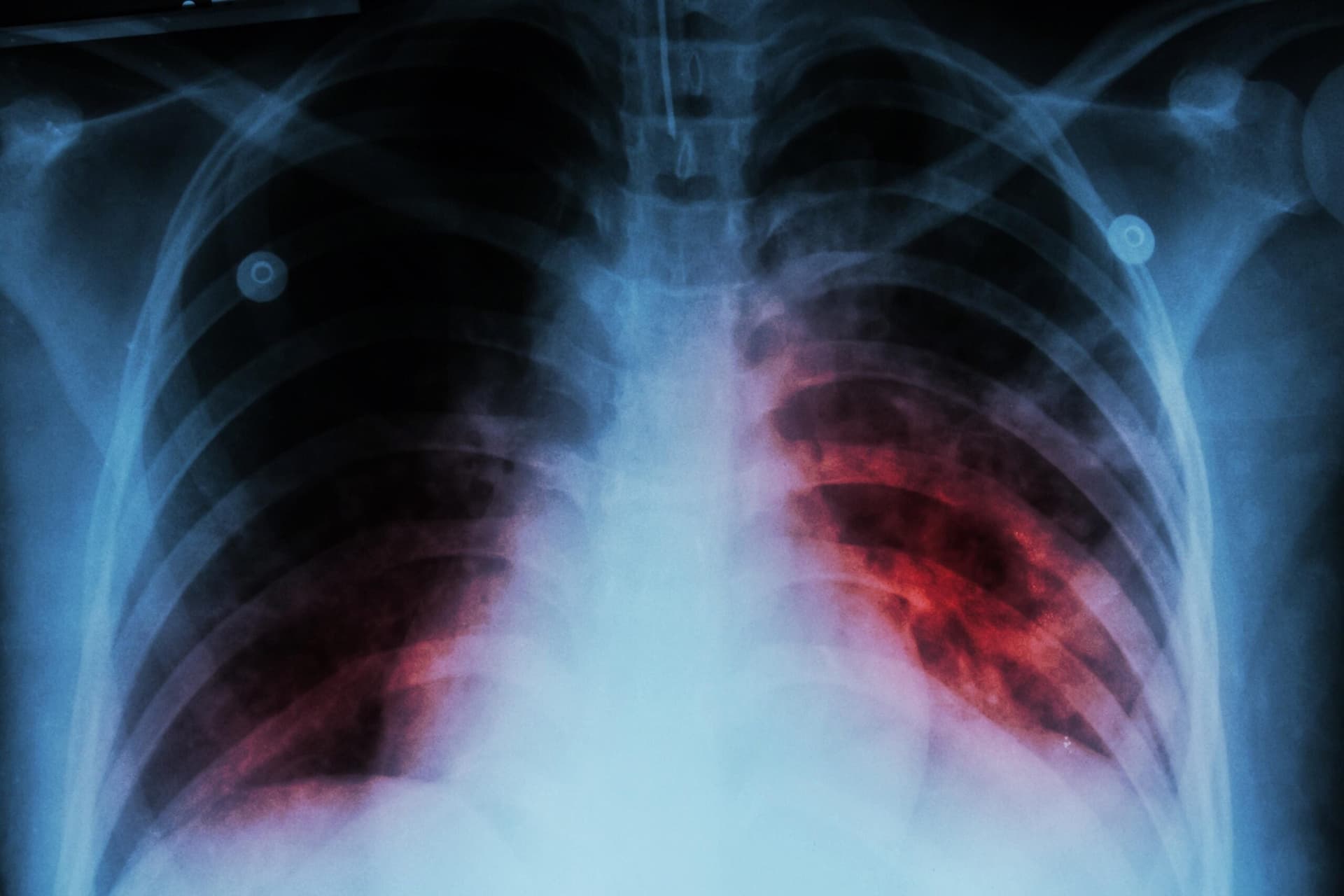 Grenada investigating tuberculosis cases as infections rise