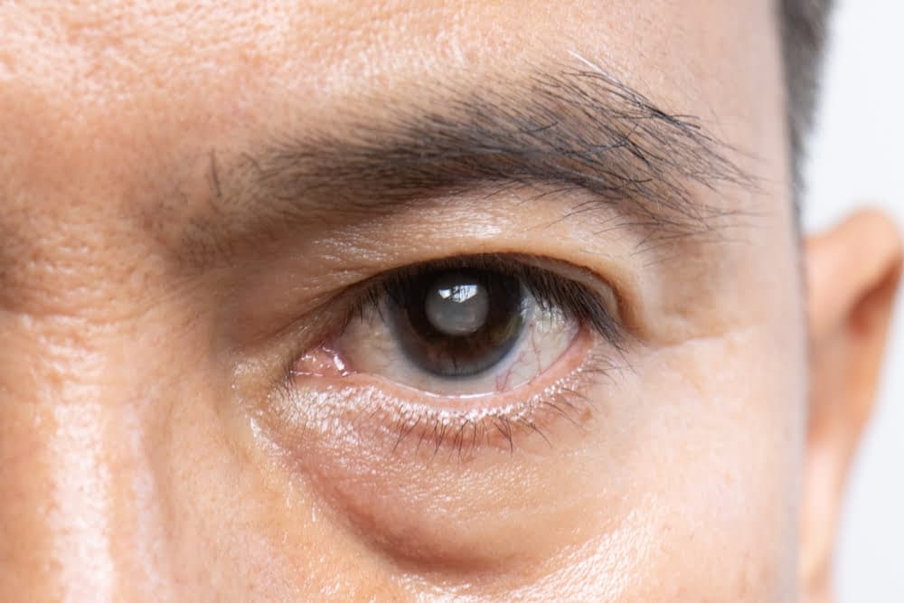 Cataract Surgery in Bonita Springs: What Medicare Covers and What It Does Not