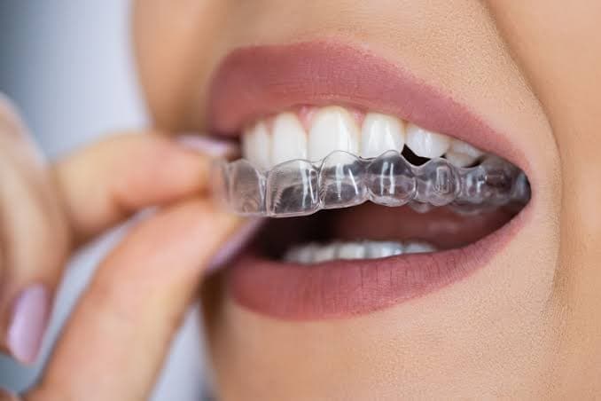 7 Daily Habits That Keep Your Clear Aligner Treatment on Track