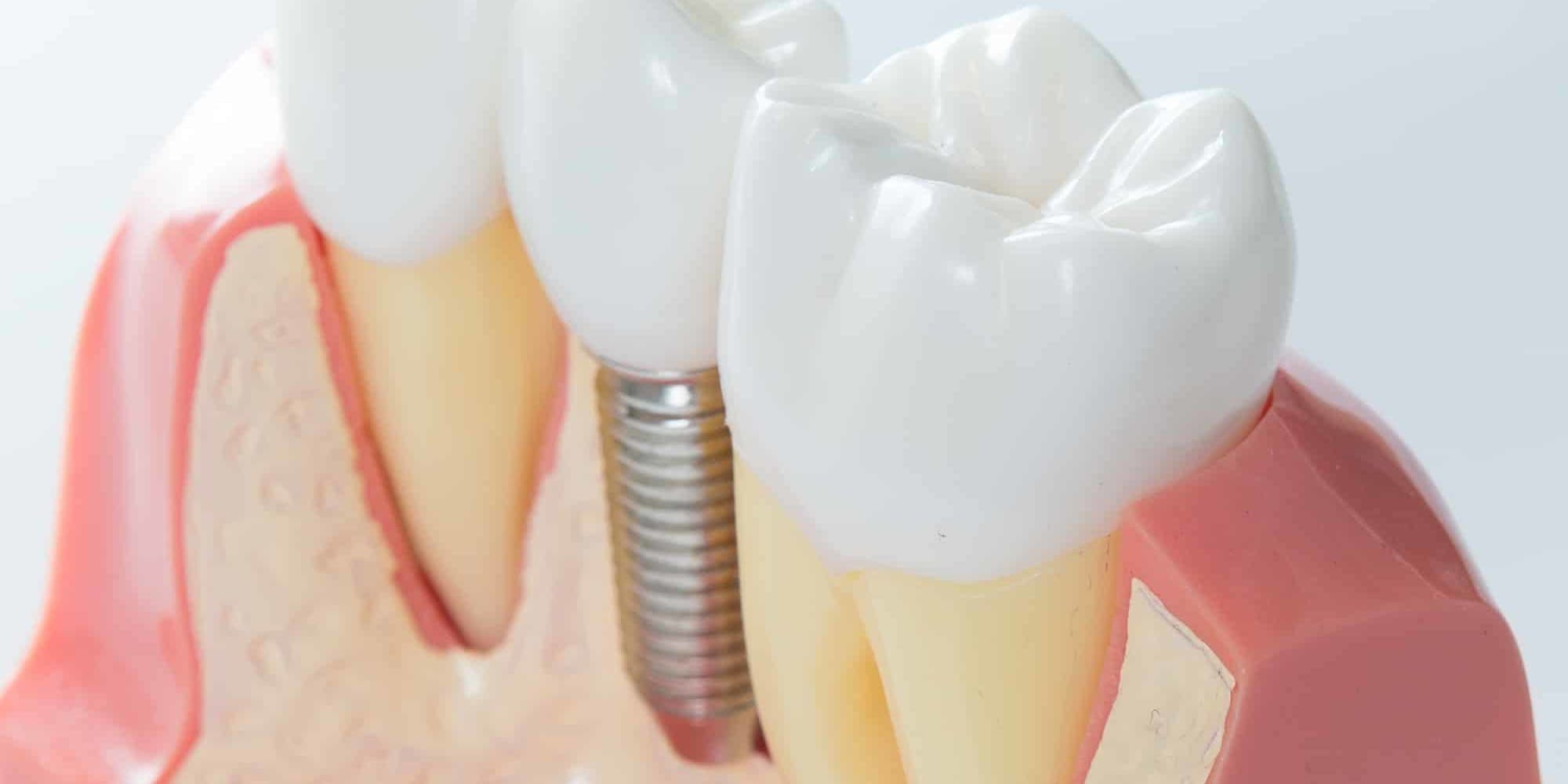 Dental Implants: The Optimal Tooth Replacement