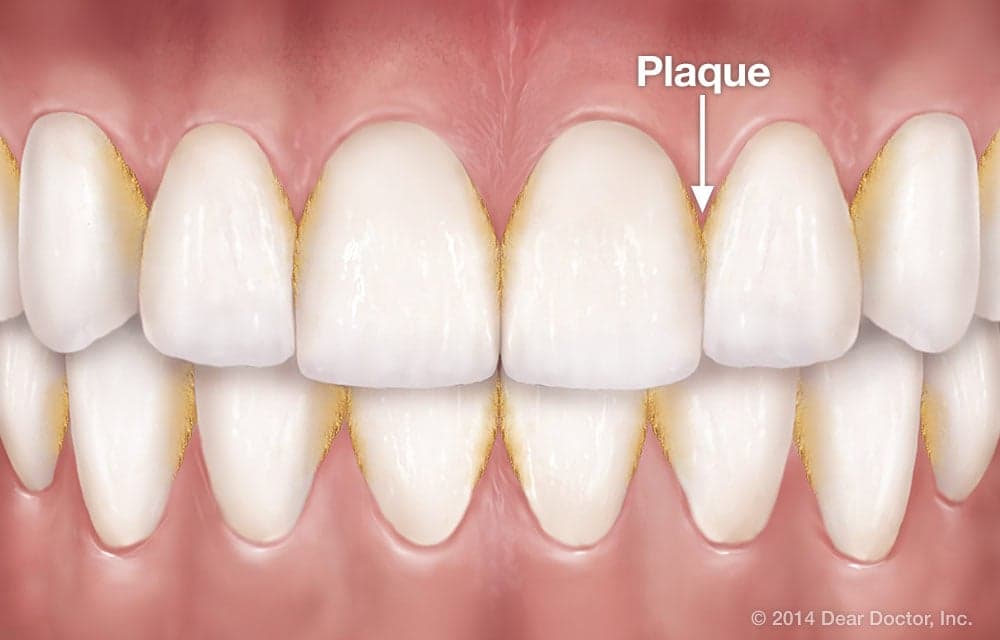 #HealthFeature: How To Protect Your Teeth From Dental Plaque