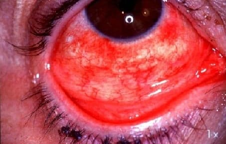 Pink eye outbreak rocks Caribbean Public Health Agency monitoring situation