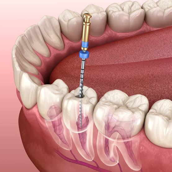 The Cheapest Root Canal Isn't Always the Cheapest: What Are You Really Paying For?