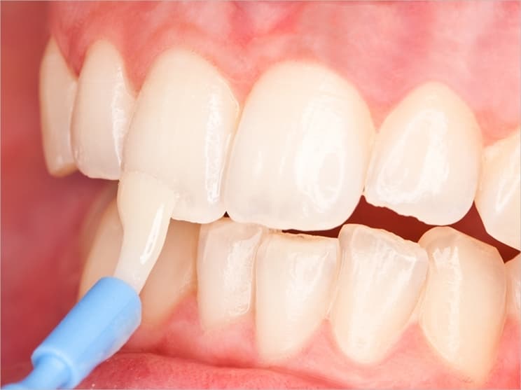 #DentalFeature: Remineralization Of Your Teeth