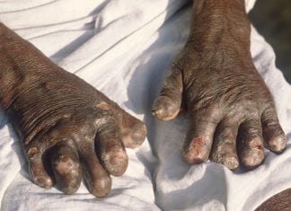 Guyana sees reduction in cases of filaria, leprosy, and TB Case of Leprosy - Caribbean National Weekly News
