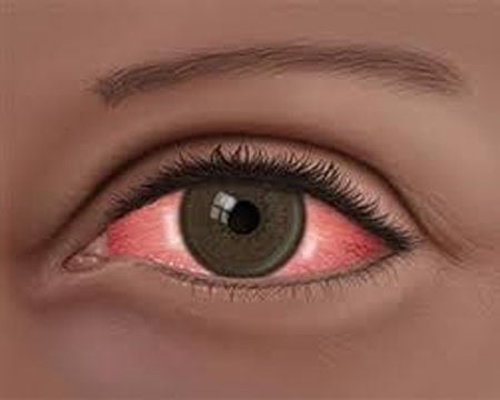 Barbados hospital restricts visit following outbreak of conjunctivitis