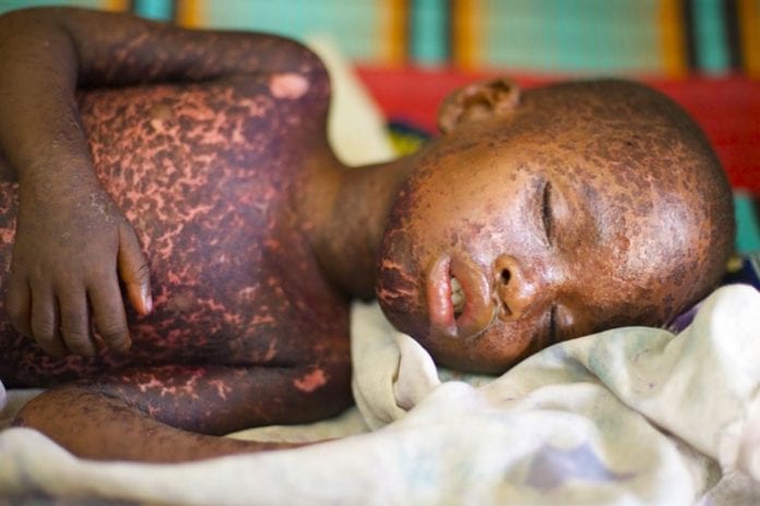 Measles