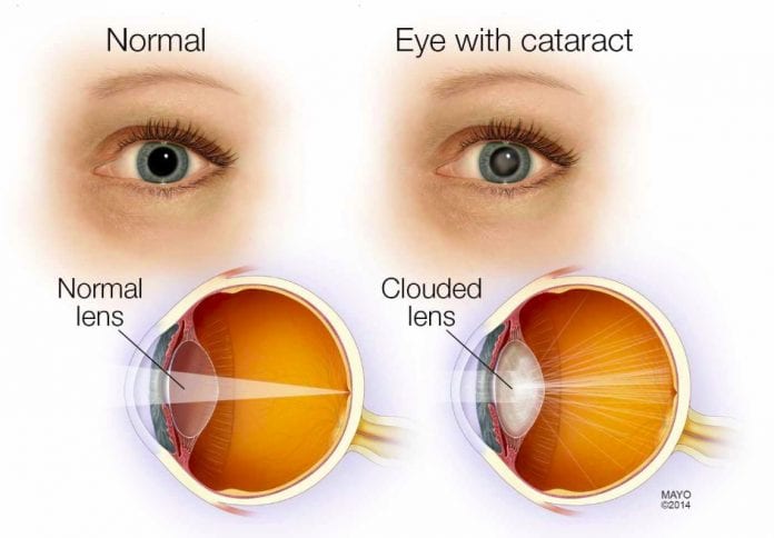 Cataracts