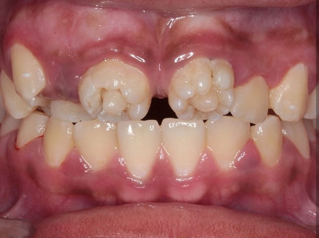HealthFeature What Are Mulberry Molars? CNW Network
