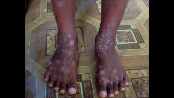 Haiti skin disease