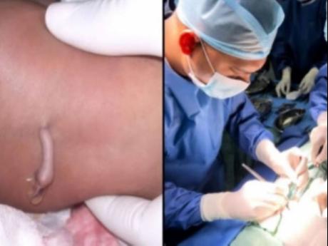 Baby born with rare ‘tail’ successfully treated in Guyana