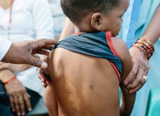 St. Lucia Health Ministry notes uptick in leprosy cases in 2023 child-leprosy-bradley-novartis