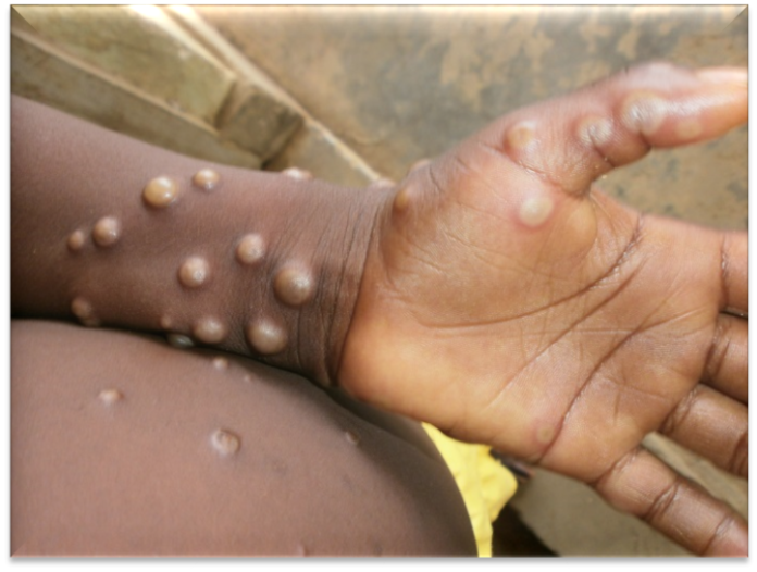 mpox