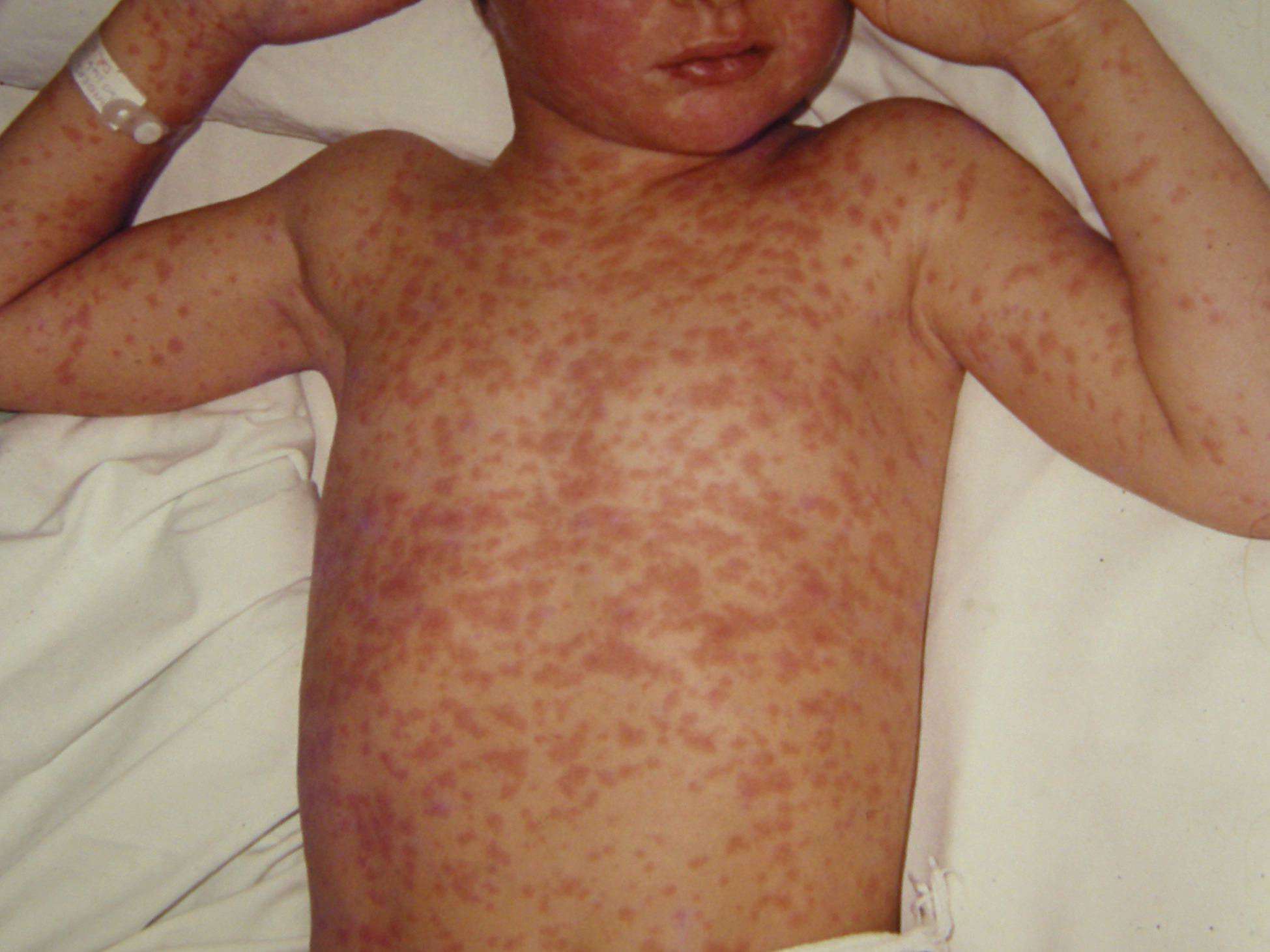 Bermuda reports 2 suspected cases measles, first in 30 years
