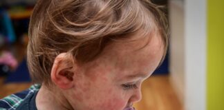 PAHO urges travelers in the Americas to boost protection against yellow fever and measles measles