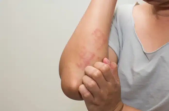 scabies