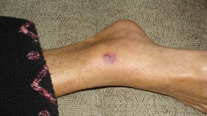 flesh-eating bacteria