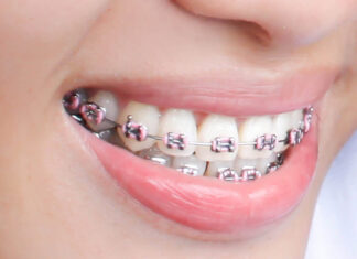 Things to know before getting braces in Johns Creek