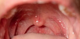 Oral Cancer Awareness Month: Why prevention and early detection matter now more than ever Oral Cancer